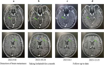 Case report: Therapeutic response to lorlatinib in advanced large-cell neuroendocrine carcinoma of the lung and breast cancer: a heterochronous double malignancy perspective